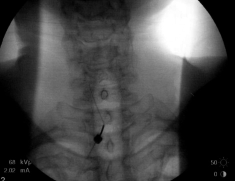 [Above is a fluoroscope image of my cervical epidural steroid injection.]
