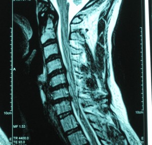 The "gray hair" of my spine.